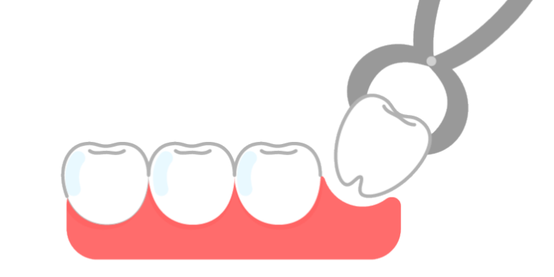 インビザラインは最小限の抜歯で済む - 奈良北葛城矯正歯科相談室