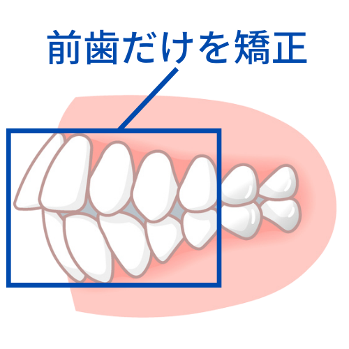 前歯だけを動かす矯正で失敗 - 奈良北葛城矯正歯科相談室