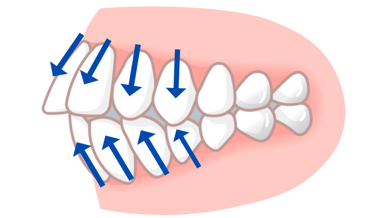 歯が外側に傾いたイラスト