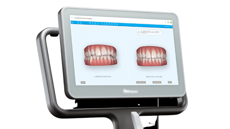 矯正治療のシミュレーション