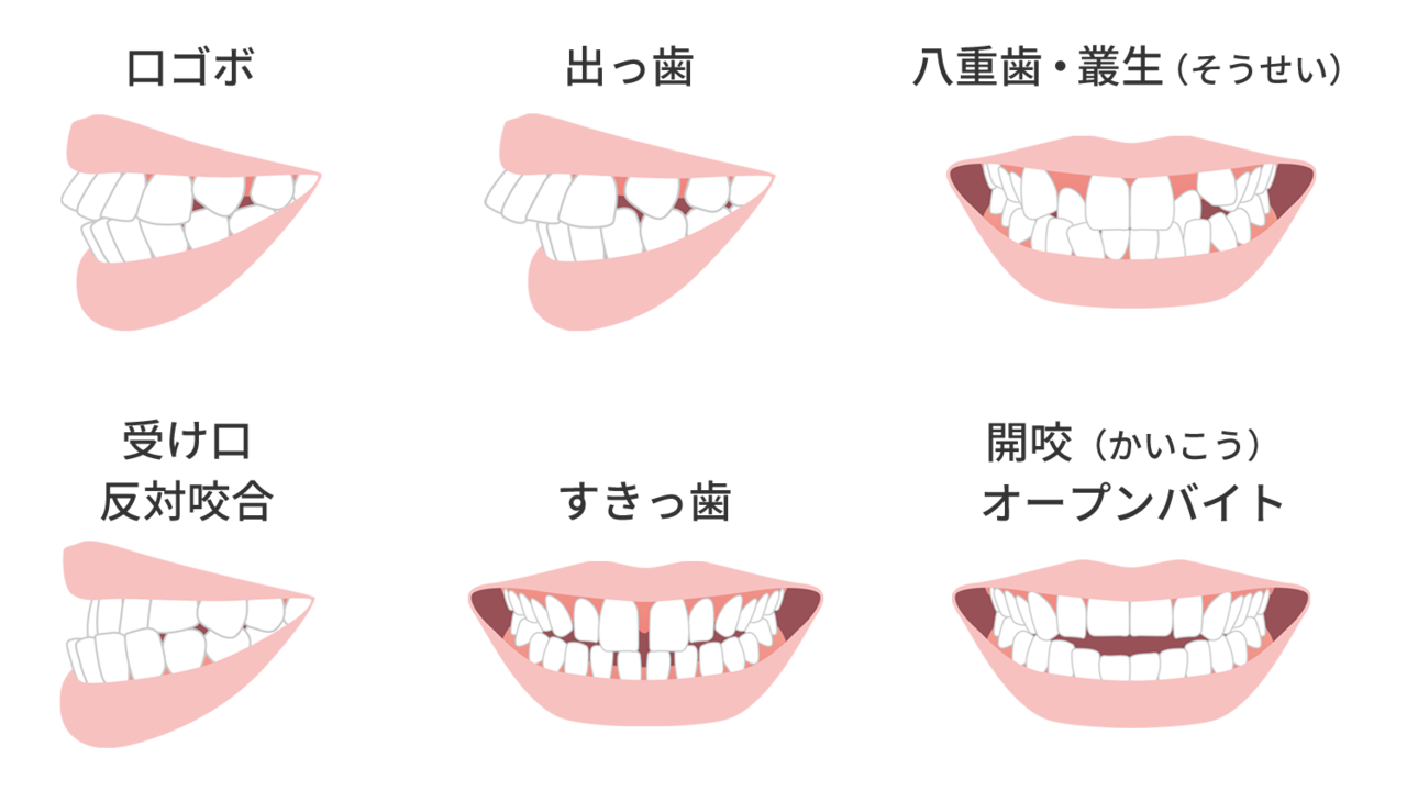 様々な歯並びのイラスト