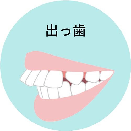 出っ歯