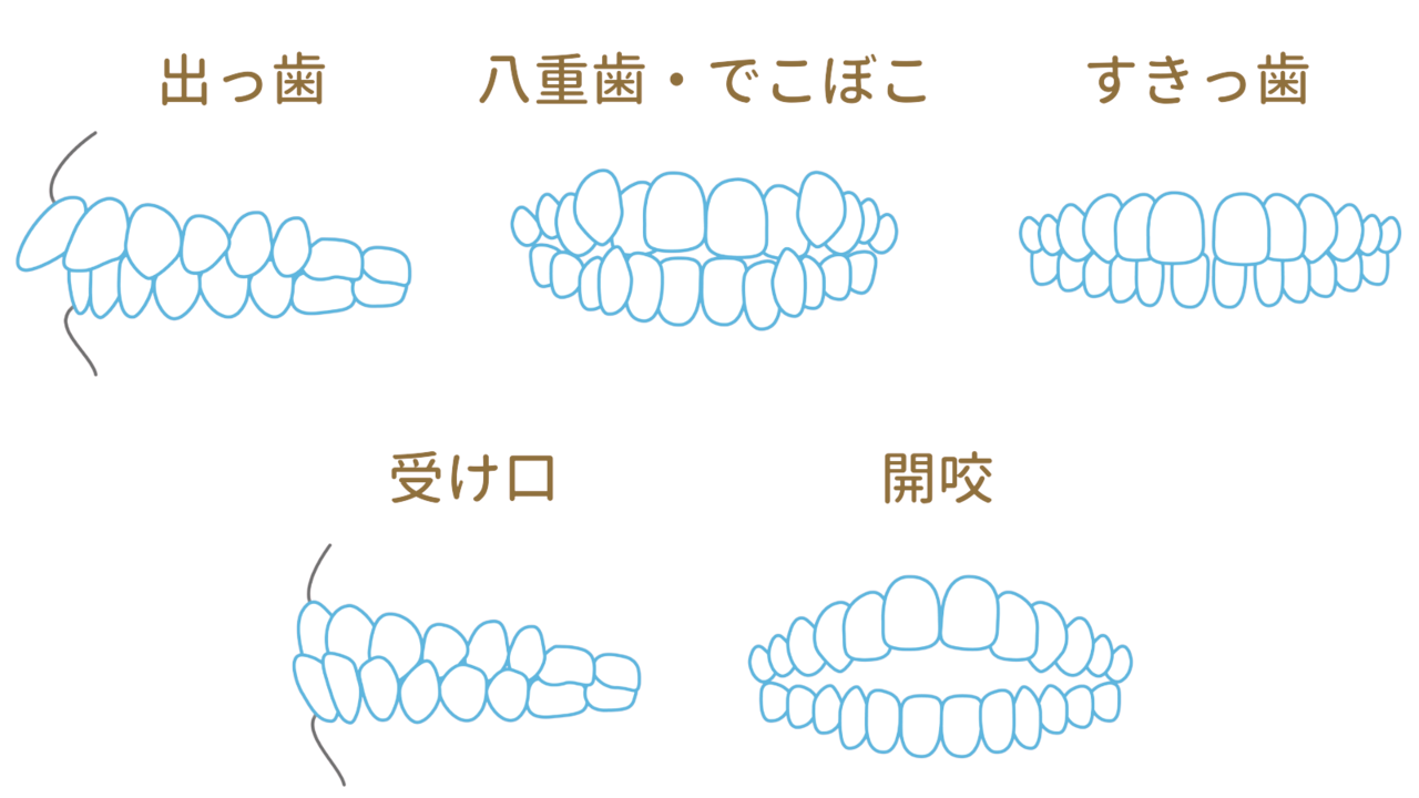 インビザラインができない症例でも大丈夫- 奈良県北葛城 矯正歯科相談室