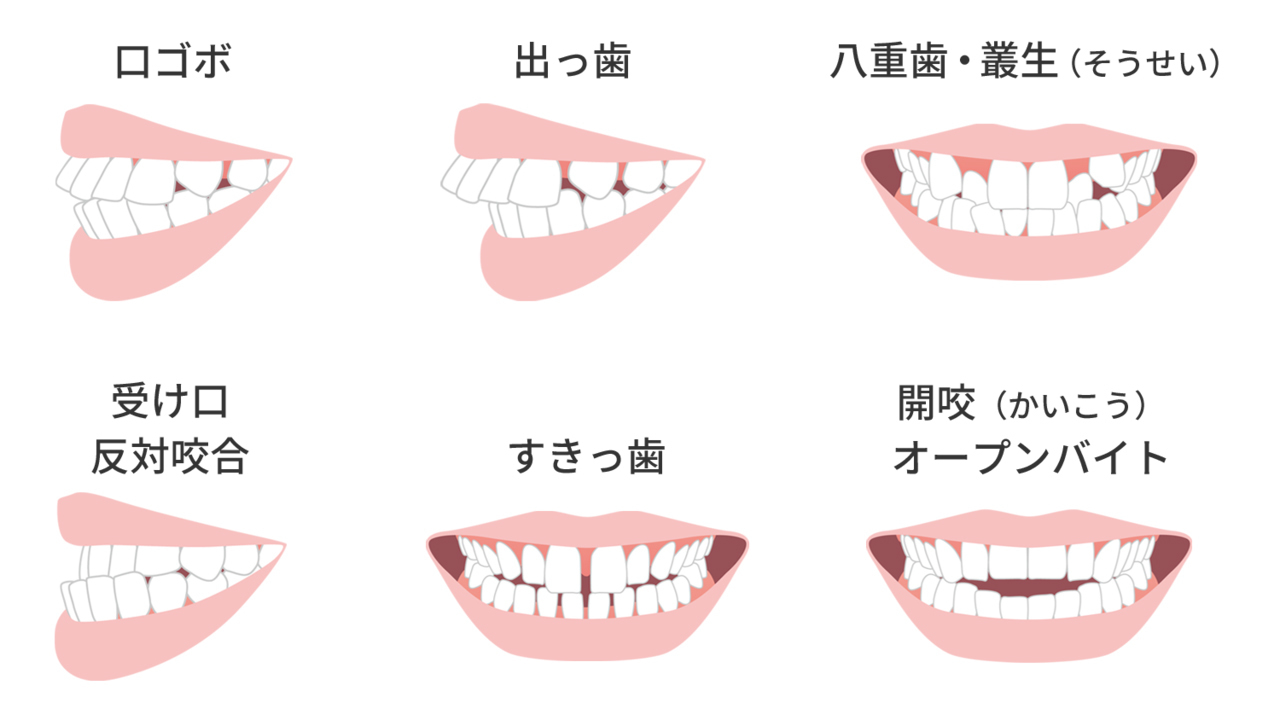 様々な歯並びのイラスト