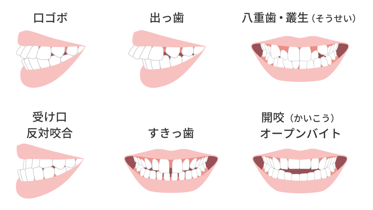 様々な歯並びの症状