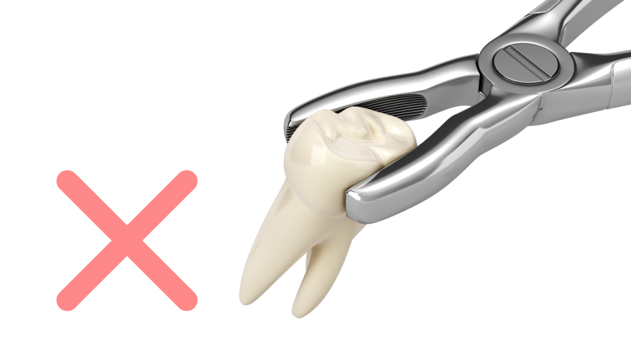 抜歯のイメージ