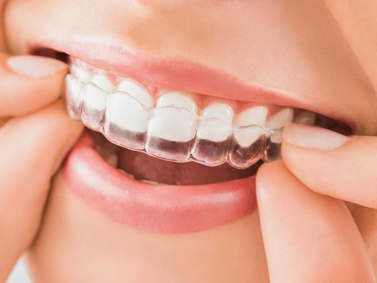 インビザライン