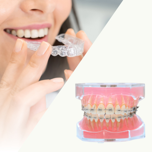 マウスピース矯正は重度の歯並びは適応外 - 奈良北葛城矯正歯科相談室