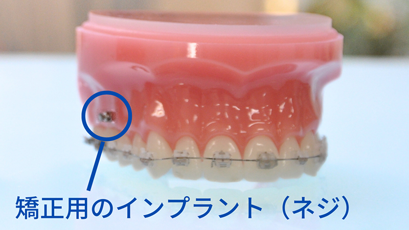 矯正用のインプラント（ネジ）