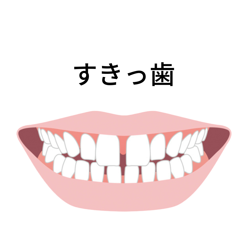 マウスピース矯正は知覚過敏やすきっ歯になるリスク - 奈良北葛城矯正歯科相談室