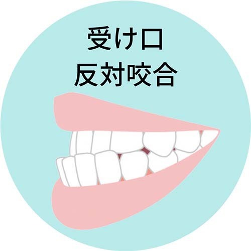 受け口