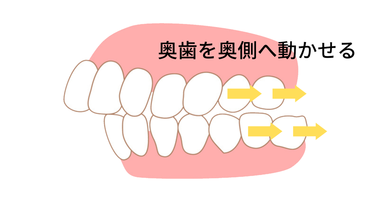 インビザラインは奥歯を動かせる - 奈良北葛城矯正歯科相談室