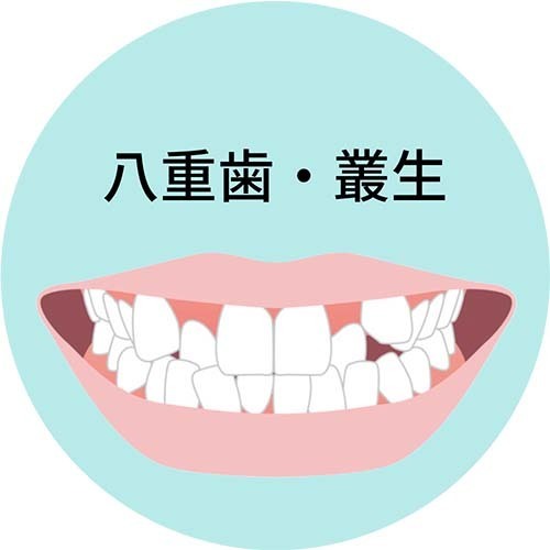 八重歯・叢生