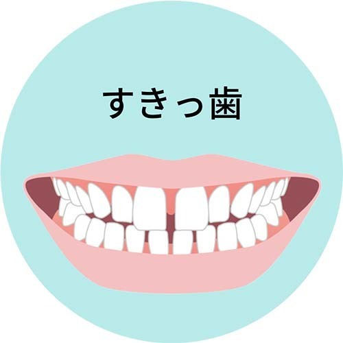 すきっ歯